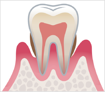 中度歯周病の図