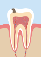 象牙質に達した虫歯のイラスト