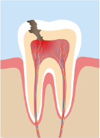 歯の神経に達した虫歯のイラスト