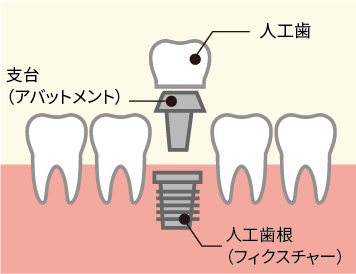 歯を失った箇所に人工歯根を埋め、その上から人工歯を乗せるインプラント治療の図