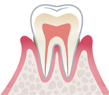 軽度歯周病の図