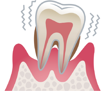 高度歯周病の図